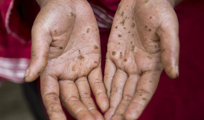 Sử dụng nước giếng khoan ô nhiễm: 10 Triệu người có nguy cơ mắc bệnh!