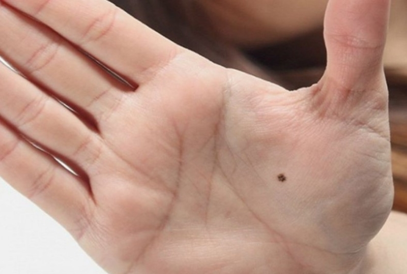 Nốt Ruồi Ở Gò Kim Tinh