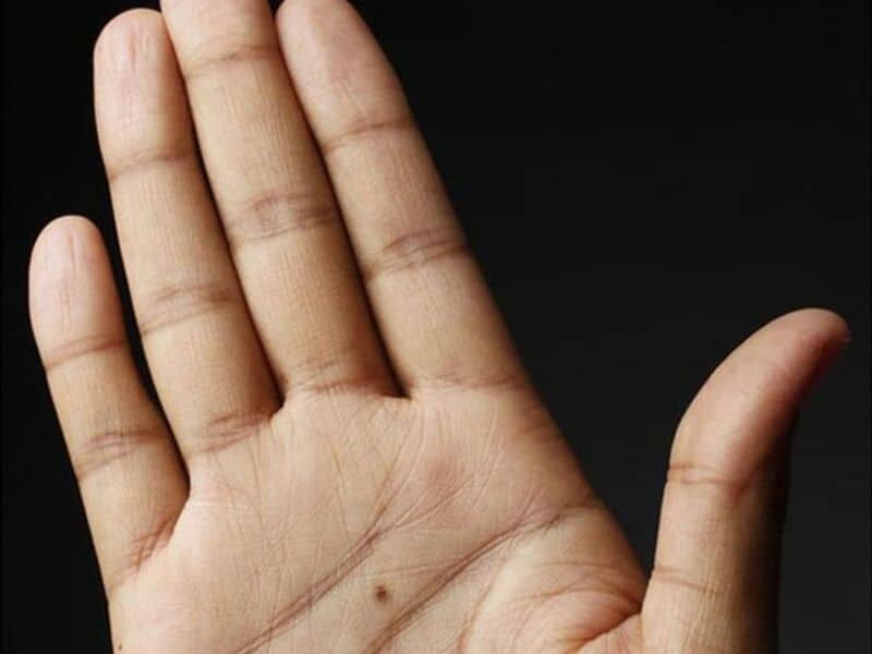 Nốt ruồi nằm ở sao. 2