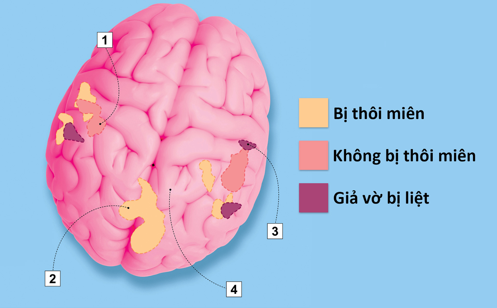 Thôi miên giấc ngủ là gì? Hiệu quả không? Liệu pháp thôi miên giác ngủ sau 5 phút